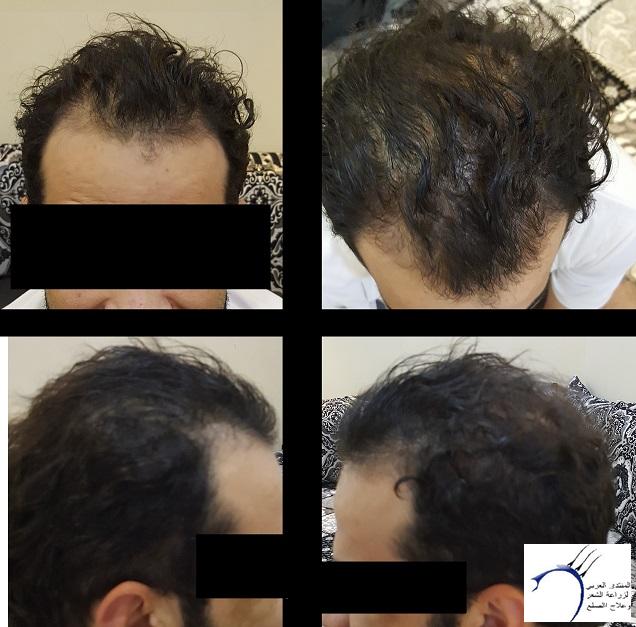 تجربة 3 اصدقاء لزراعة الشعر في تركيا في وقت واحد ايست اثيكا P_5722fgt97