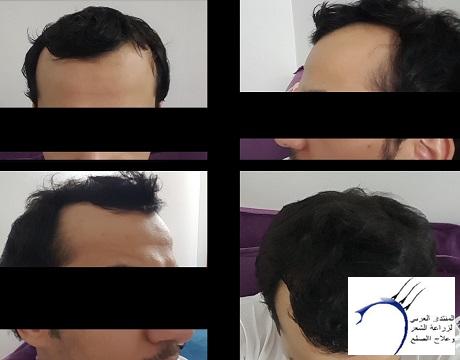 تجربة 3 اصدقاء لزراعة الشعر في تركيا في وقت واحد ايست اثيكا P_572aukui1